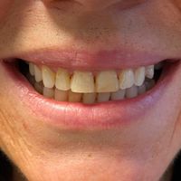 Composite Bonding - Smile 2 before